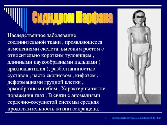 http://medarticle37.moslek.ru/articles/15184.htm Сидндром Марфана Наследственное заболевание соединительной ткани , проявляющееся изменениями скелета: