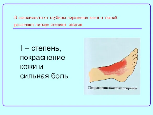 В зависимости от глубины поражения кожи и тканей различают четыре степени