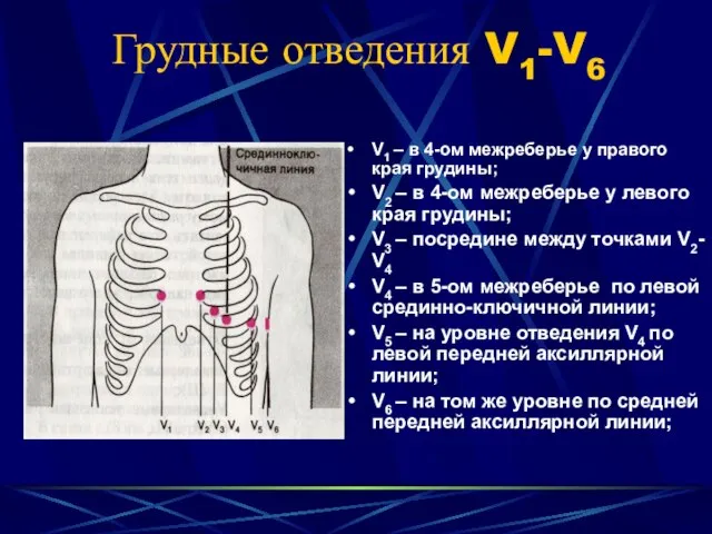 Грудные отведения V1-V6 V1 – в 4-ом межреберье у правого края