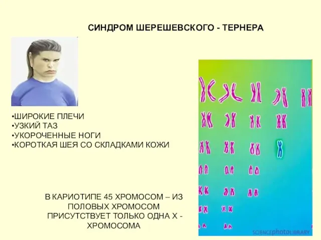 СИНДРОМ ШЕРЕШЕВСКОГО - ТЕРНЕРА В КАРИОТИПЕ 45 ХРОМОСОМ – ИЗ ПОЛОВЫХ