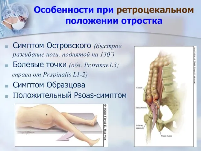 Особенности при ретроцекальном положении отростка Симптом Островского (быстрое разгибание ноги, поднятой