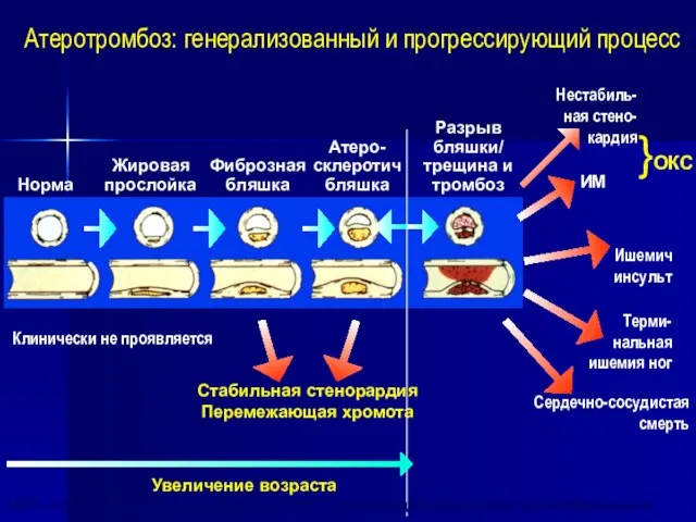 Норма Жировая прослойка Фиброзная бляшка Атеро- склеротич бляшка Разрыв бляшки/ трещина