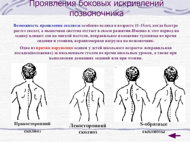 Проявления боковых искривлений позвоночника Возможность проявления сколиоза особенно велика в возрасте