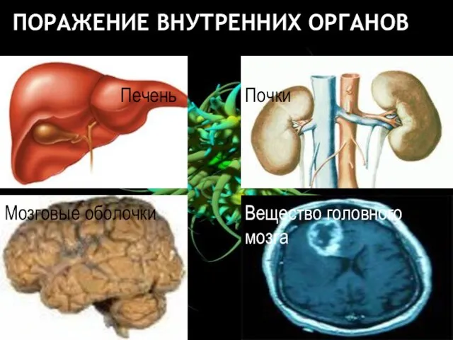 ПОРАЖЕНИЕ ВНУТРЕННИХ ОРГАНОВ Печень Почки Мозговые оболочки Вещество головного мозга