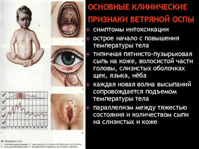 ОСНОВНЫЕ КЛИНИЧЕСКИЕ ПРИЗНАКИ ВЕТРЯНОЙ ОСПЫ симптомы интоксикации острое начало с повышения