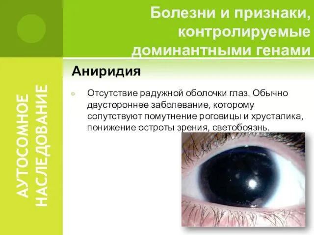 АУТОСОМНОЕ НАСЛЕДОВАНИЕ Аниридия Отсутствие радужной оболочки глаз. Обычно двустороннее заболевание, которому