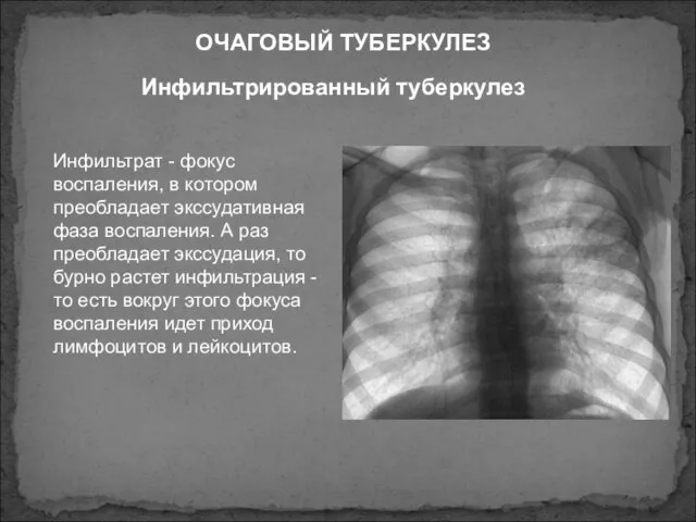 Инфильтрированный туберкулез ОЧАГОВЫЙ ТУБЕРКУЛЕЗ Инфильтрат - фокус воспаления, в котором преобладает