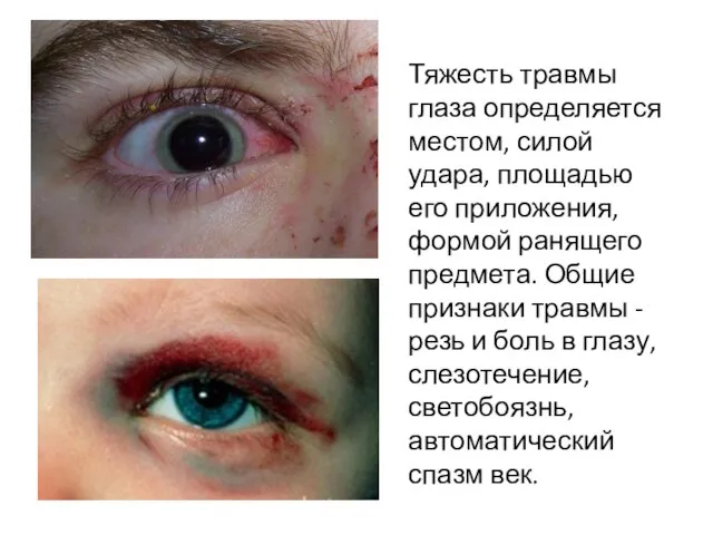 Тяжесть травмы глаза определяется местом, силой удара, площадью его приложения, формой