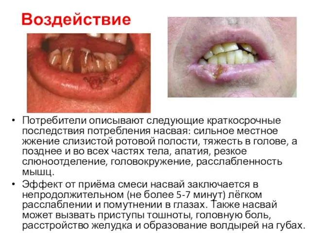 Воздействие Потребители описывают следующие краткосрочные последствия потребления насвая: сильное местное жжение