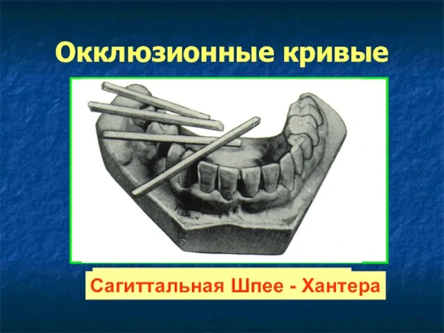 Окклюзионные кривые Трансверсальная Уилсона Сагиттальная Шпее - Хантера