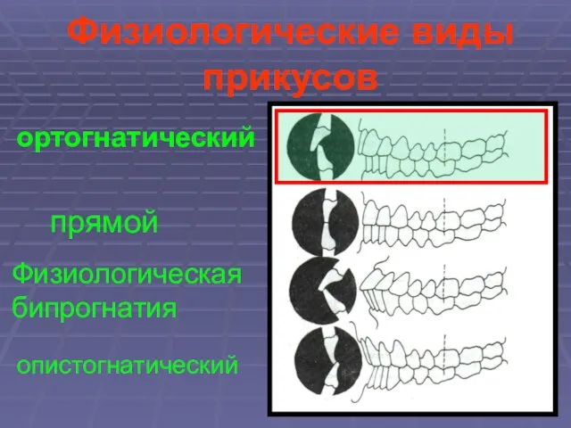 Физиологические виды прикусов прямой ортогнатический Физиологическая бипрогнатия опистогнатический