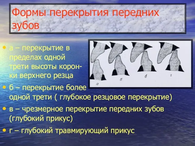 Формы перекрытия передних зубов а – перекрытие в пределах одной трети