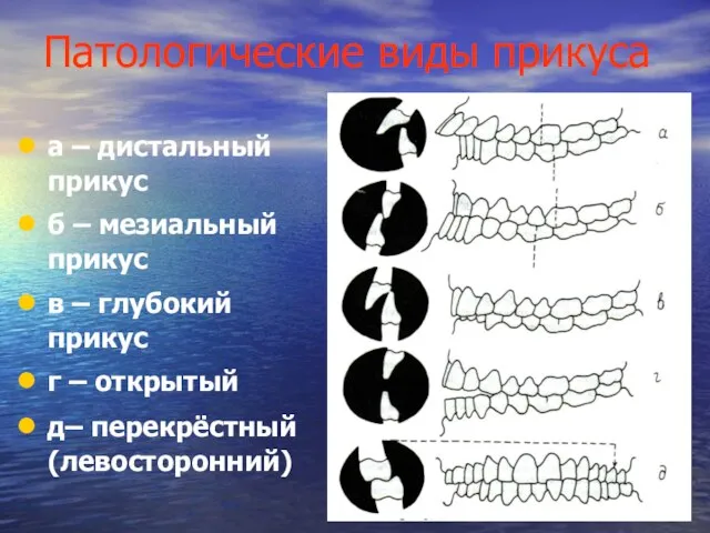 Патологические виды прикуса а – дистальный прикус б – мезиальный прикус