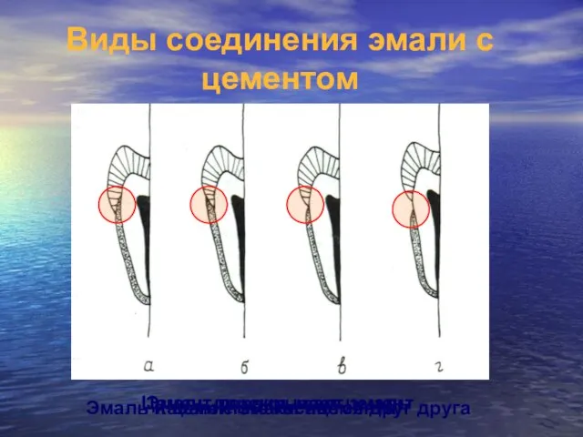 Эмаль перекрывает цемент Цемент перекрывает эмаль Касание эмали ицемента Эмаль и