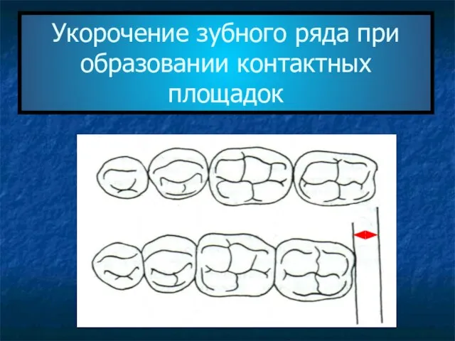 Укорочение зубного ряда при образовании контактных площадок