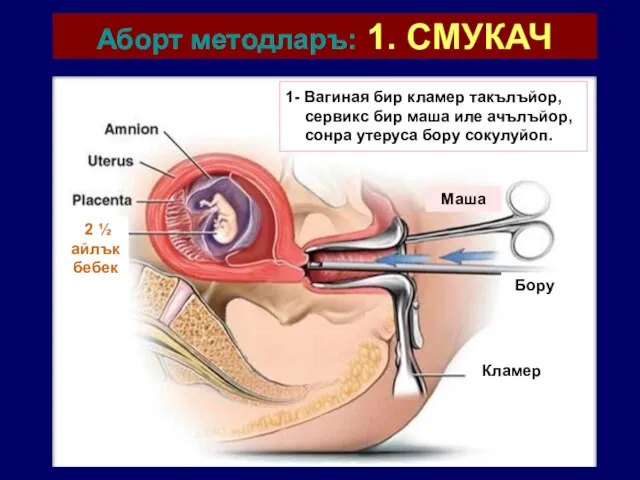 Аборт методларъ: 1. СМУКАЧ Кламер Бору Маша 1- Вагиная бир кламер