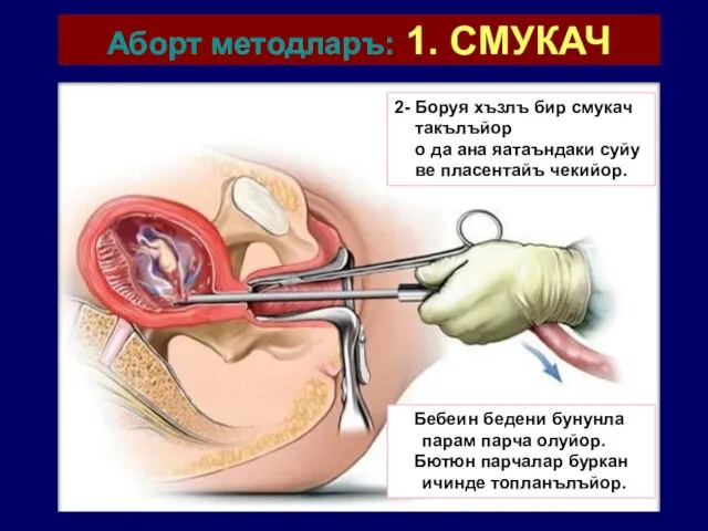 Аборт методларъ: 1. СМУКАЧ 2- Боруя хъзлъ бир смукач такълъйор о