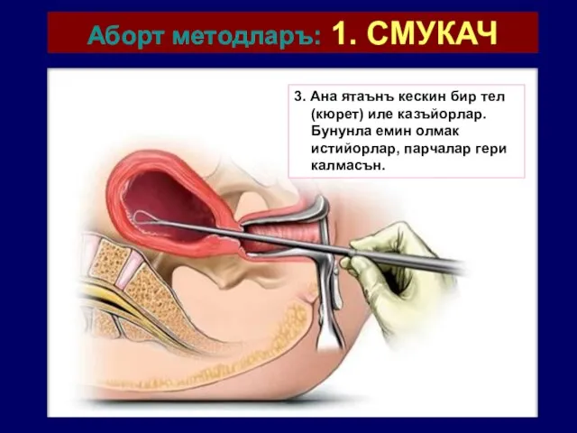 Аборт методларъ: 1. СМУКАЧ 3. Ана ятаънъ кескин бир тел (кюрет)