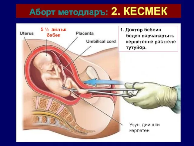 Аборт методларъ: 2. КЕСМЕК 1. Доктор бебеин беден парчаларънъ керпетенле растгеле