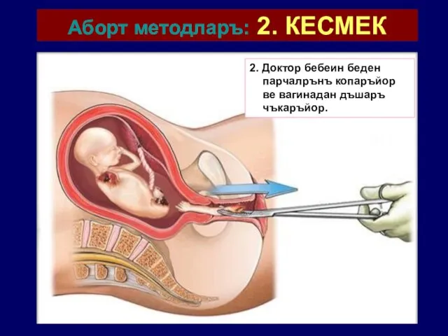 Аборт методларъ: 2. КЕСМЕК 2. Доктор бебеин беден парчалрънъ копаръйор ве вагинадан дъшаръ чъкаръйор.