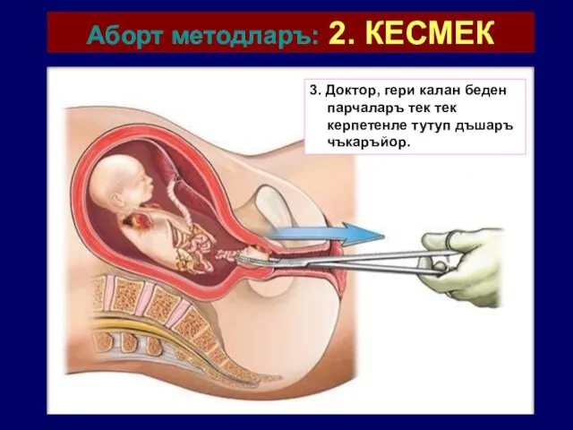 Аборт методларъ: 2. КЕСМЕК 3. Доктор, гери калан беден парчаларъ тек тек керпетенле тутуп дъшаръ чъкаръйор.