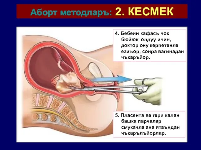 Аборт методларъ: 2. КЕСМЕК 4. Бебеин кафасъ чок бюйюк олдуу ичин,