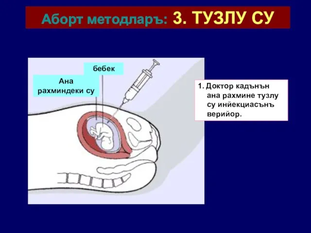 Аборт методларъ: 3. ТУЗЛУ СУ 1. Доктор кадънън ана рахмине тузлу су инйекциасънъ верийор.