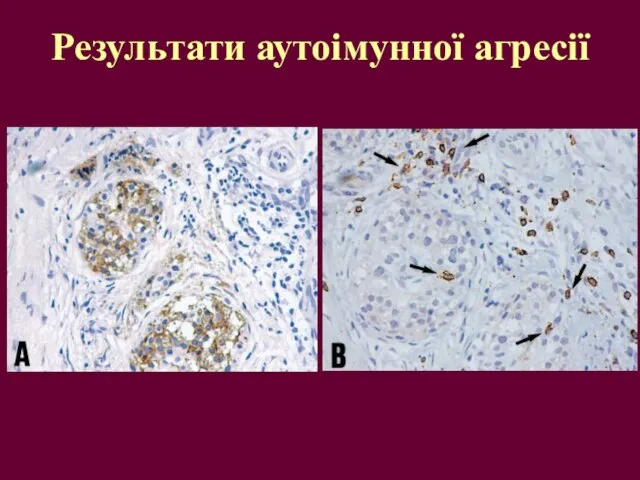 Результати аутоімунної агресії