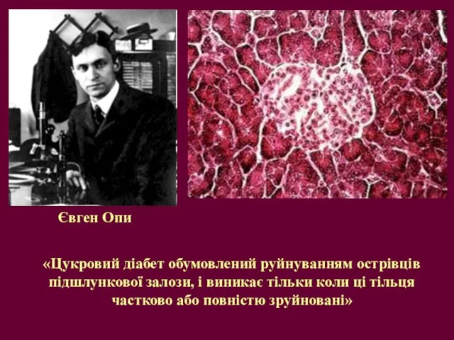 Євген Опи «Цукровий діабет обумовлений руйнуванням острівців підшлункової залози, і виникає