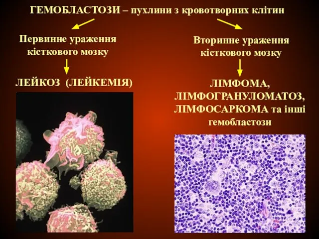 ГЕМОБЛАСТОЗИ – пухлини з кровотворних клітин Первинне ураження кісткового мозку ЛЕЙКОЗ