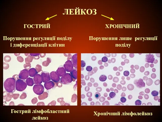 ЛЕЙКОЗ ГОСТРИЙ Порушення регуляції поділу і диференціації клітин ХРОНІЧНИЙ Порушення лише