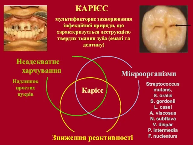 КАРІЄС мультифакторне захворювання інфекційної природи, що характеризується деструкцією твердих тканин зуба