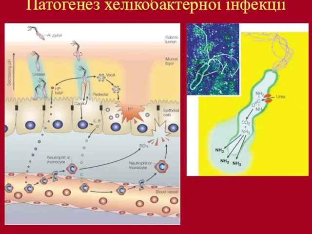 Патогенез хелікобактерної інфекції