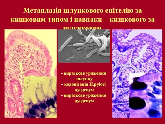 Метаплазія шлункового епітелію за кишковим типом і навпаки – кишкового за