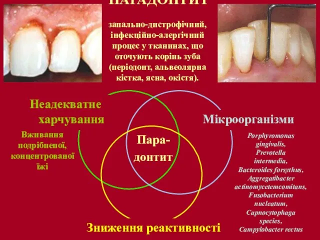 ПАРАДОНТИТ запально-дистрофічний, інфекційно-алергічний процес у тканинах, що оточують корінь зуба (періодонт,