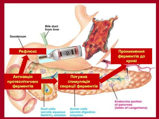 Активація протеолітичних ферментів Активація протеолітичних ферментів Рефлюкс Само-перетравлювання панкреас Проникнення ферментів