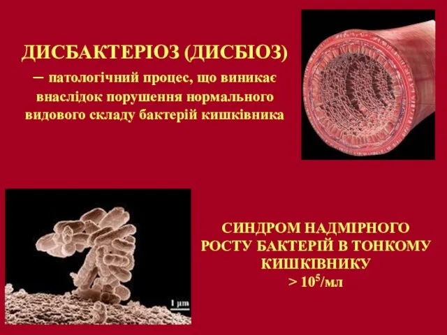 ДИСБАКТЕРІОЗ (ДИСБІОЗ) – патологічний процес, що виникає внаслідок порушення нормального видового