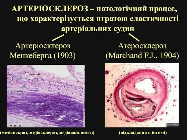 АРТЕРІОСКЛЕРОЗ – патологічний процес, що характерізується втратою еластичності артеріальних судин Атеросклероз