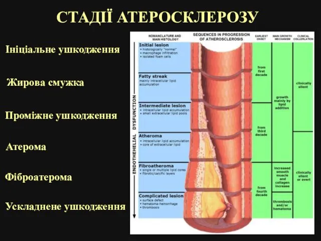 СТАДІЇ АТЕРОСКЛЕРОЗУ Ініціальне ушкодження Жирова смужка Проміжне ушкодження Атерома Фіброатерома Ускладнене ушкодження