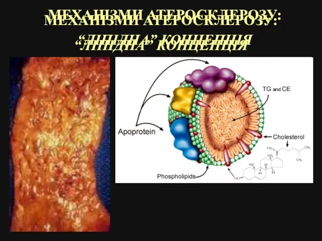 МЕХАНІЗМИ АТЕРОСКЛЕРОЗУ: “ЛІПІДНА” КОНЦЕПЦІЯ МЕХАНІЗМИ АТЕРОСКЛЕРОЗУ: “ЛІПІДНА” КОНЦЕПЦІЯ