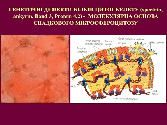 ГЕНЕТИЧНІ ДЕФЕКТИ БІЛКІВ ЦИТОСКЕЛЕТУ (spectrin, ankyrin, Band 3, Protein 4.2) - МОЛЕКУЛЯРНА ОСНОВА СПАДКОВОГО МІКРОСФЕРОЦИТОЗУ