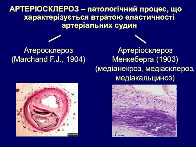 АРТЕРІОСКЛЕРОЗ – патологічний процес, що характерізується втратою еластичності артеріальних судин Атеросклероз
