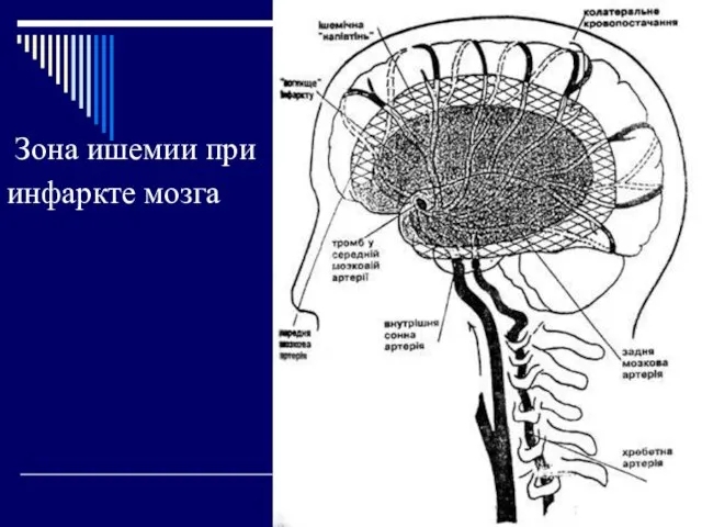 Зона ишемии при инфаркте мозга