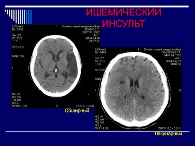 ИШЕМИЧЕСКИЙ ИНСУЛЬТ Лакунарный Обширный