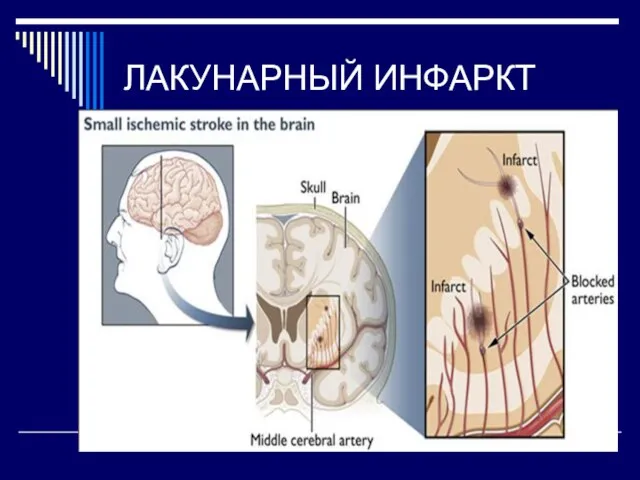 ЛАКУНАРНЫЙ ИНФАРКТ