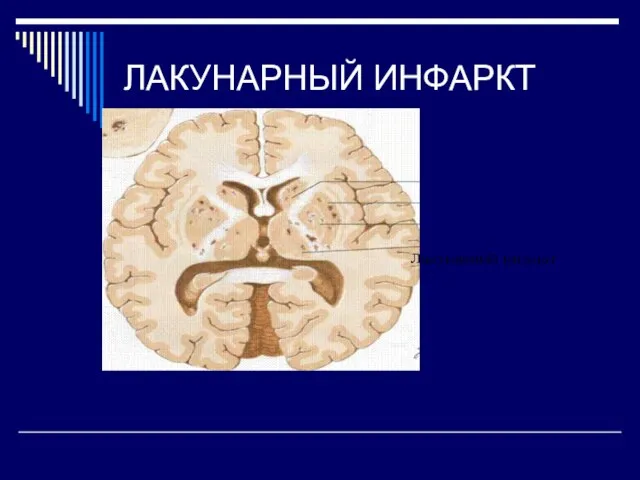 ЛАКУНАРНЫЙ ИНФАРКТ