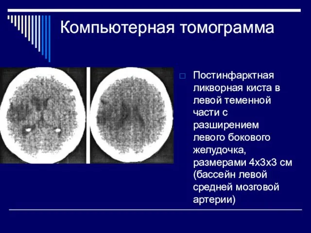 Компьютерная томограмма Постинфарктная ликворная киста в левой теменной части с разширением