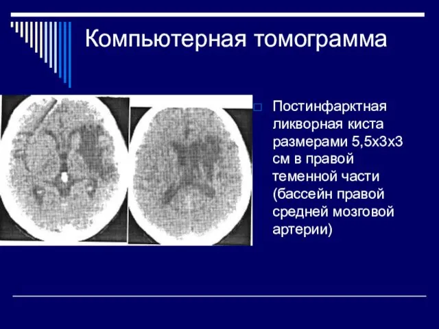 Компьютерная томограмма Постинфарктная ликворная киста размерами 5,5x3х3 см в правой теменной