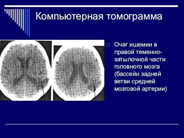 Компьютерная томограмма Очаг ишемии в правой теменно-затылочной части головного мозга (бассейн задней ветви средней мозговой артерии)