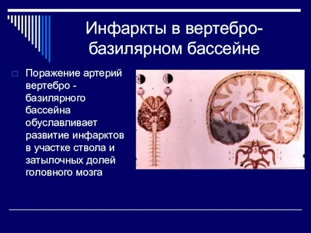 Инфаркты в вертебро-базилярном бассейне Поражение артерий вертебро -базилярного бассейна обуславливает развитие